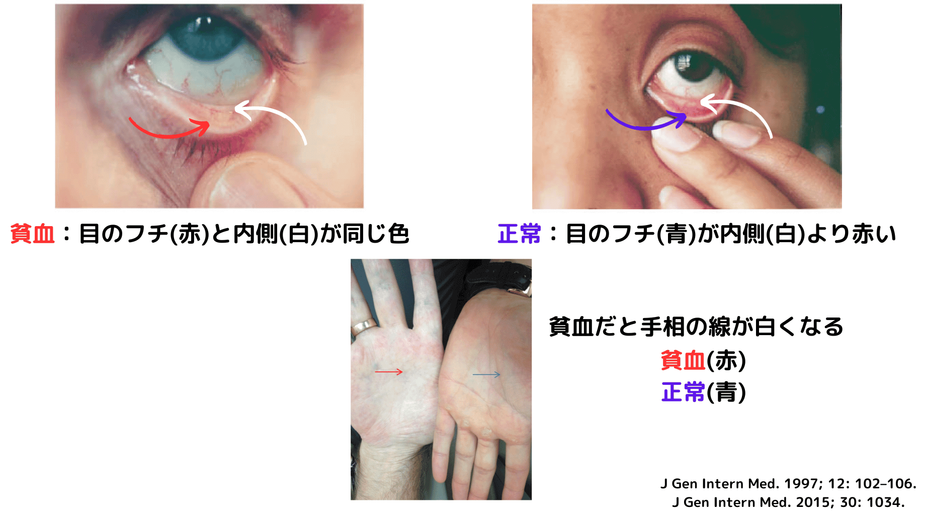 鉄分のサプリメントを摂取する